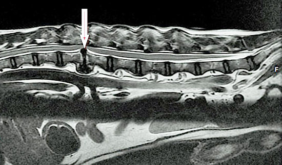 IRM-hernie-discale IRM hernie discale