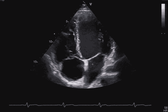 echocardio échocardiographie