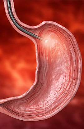 endoscopie-estomac Endoscopie estomac