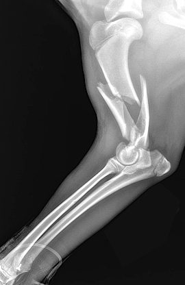 radio-numerique radio fracture humérus