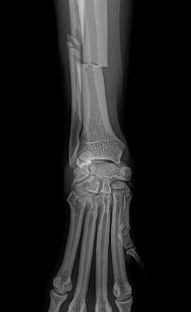 Fracture radius ulna chien