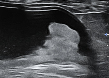 échographie masse vésicale